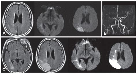 A: Brain MRI on admission shows an acute right parietal lobe infarction ...