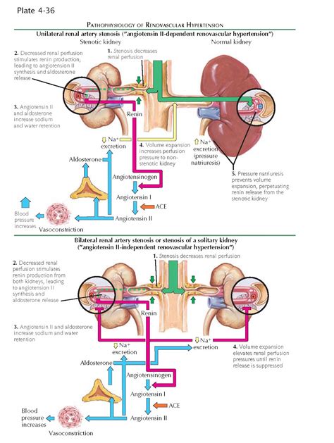 RENAL ARTERY STENOSIS - pediagenosis