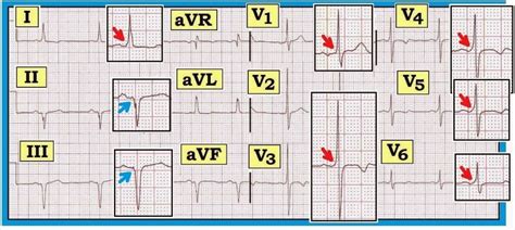 ECG Interpretation: ECG Interpretation Review #81 (Tall R Wave in Lead V1 – RVH – WPW ...