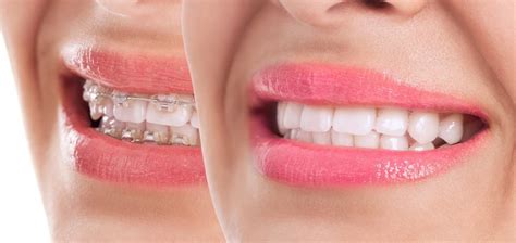 How To Get White Teeth With Braces: 5 Ways to Keep Your Teeth Whiter