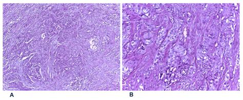 Pharyngolaringeal Neoplasm Treated with Surgery and Radiotherapy ...