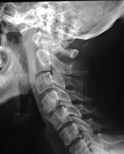 Cervical Ankylosing Spondylitis X Ray