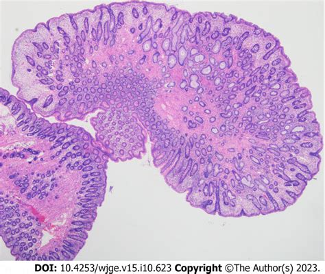 Histology of ascending colon polyp. | Download Scientific Diagram