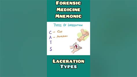 Laceration : Types - mnemonic | Forensic Medicine , Surgery | #shorts - YouTube