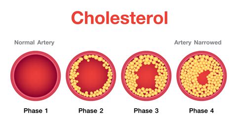 Dealing with atherosclerosis