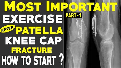 MOST IMPORTANT EXERCISE AFTER PATELLA FRACTURE | PATELLA FRACTURE EXERCISE | HEALTH MADE EASY ...