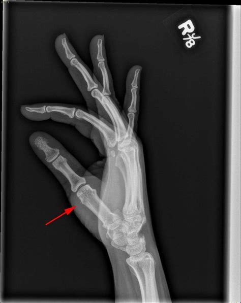 Radial collateral ligament avulsion - X Rays Case Studies - CTisus CT ...