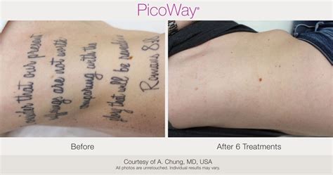 PicoWay Laser Tattoo Removal – Synergy Medical Aesthetics – Nanaimo, Victoria, Vancouver Island