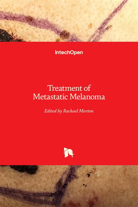 Treatment of Metastatic Melanoma | IntechOpen