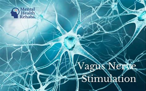 What to know before getting a Vagus Nerve Stimulation Device