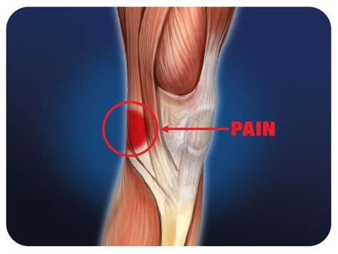 Leg Tendon Behind Knee / Pin on Anatomy - Tendons are thick bands of ...