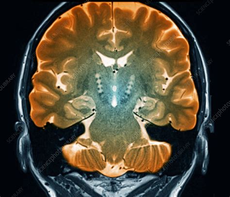 Parkinson's disease, MRI scan - Stock Image - C052/8785 - Science Photo Library