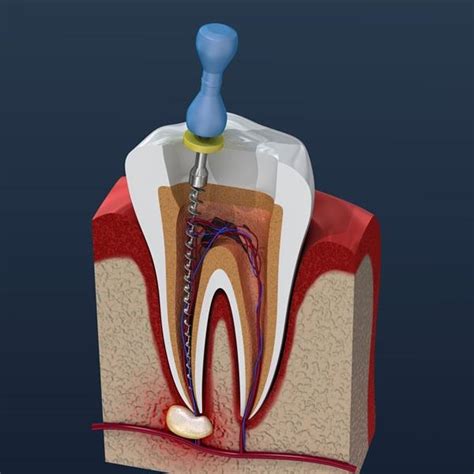 Endodontics (Root Canal) • Synergy Dental Clinics