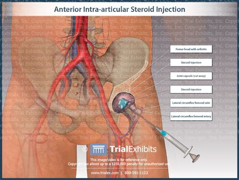 Anterior Intra-Articular Steroid Injection | Trial Exhibits, Inc.