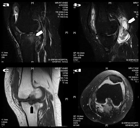 Rheumatoid Arthritis Knee Mri