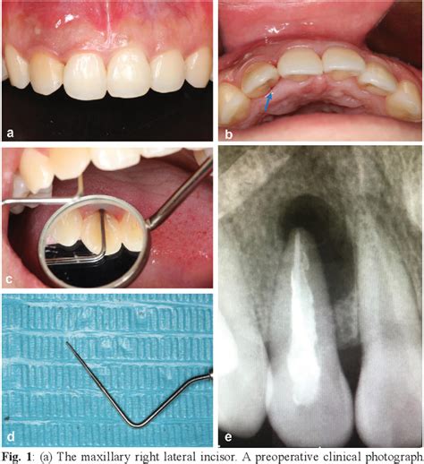 Figure 1 from Study of the intentional replantation procedure used to treat a tooth with a ...