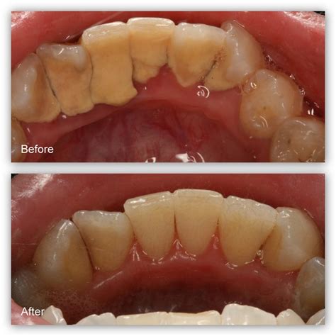 Gum Disease Gallery - Hosner Family Dentistry