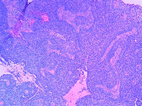 BASALOID SQUAMOUS CELL CARCINOMA – Histopathology.guru