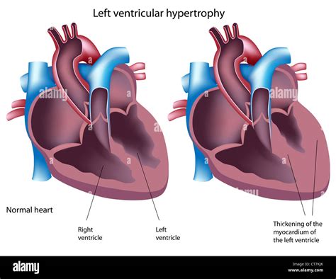 Left ventricular hypertrophy Stock Photo - Alamy