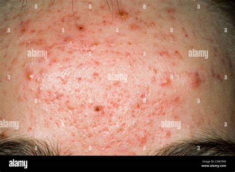 erythematous rash on forehead of acne with comedones pustules and Stock Photo, Royalty Free ...