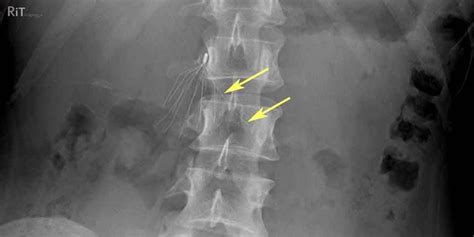 RiT radiology: Inferior Vena Cava (IVC) Filter Fracture