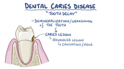 Dental caries disease: Video, Anatomy & Definition | Osmosis