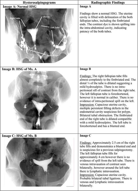 Images A, B & C: Compared to normal findings on hysterosalpingogram... | Download Scientific Diagram