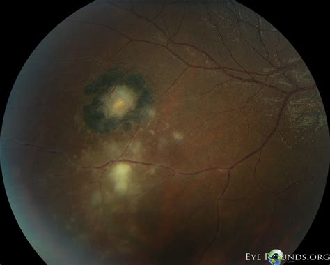 Atlas Entry - Ocular Toxoplasmosis