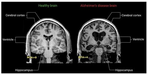 IJMS | Free Full-Text | Imaging Techniques in Alzheimer’s Disease: A Review of Applications in ...