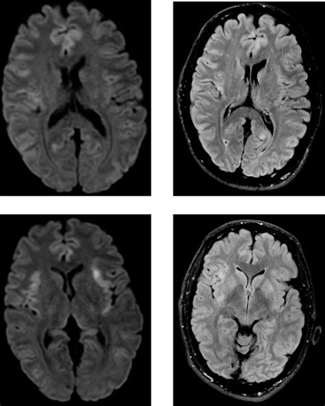 Magnetic resonance imaging (MRI) of the brain. MRI showed a high signal... | Download Scientific ...