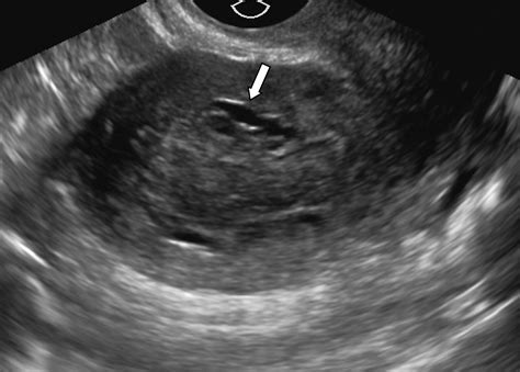 Adenomyosis: A Sonographic Diagnosis | RadioGraphics