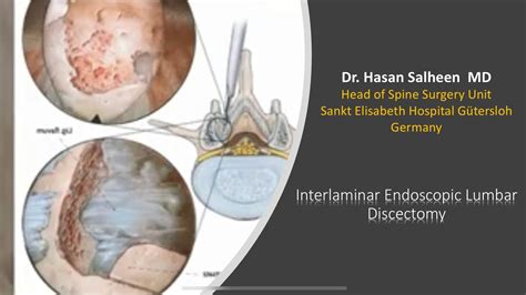 Endoscopic Interlaminar approach - YouTube