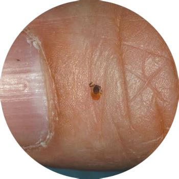 Tick Bites/Prevention | Tick-borne Diseases | Ticks | CDC