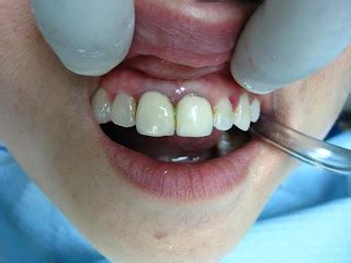 My ♥ Dentistry ☆: PFM Crown change to Full Cramic Crown