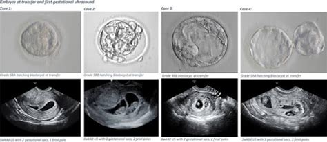 Procedures After Embryo Transfer Day By Day - Aastha Fertility