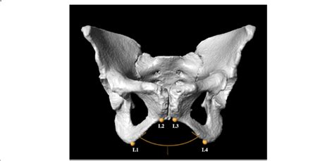 Pelvic image showing subpubic angle measurement using the Checkpoint ...