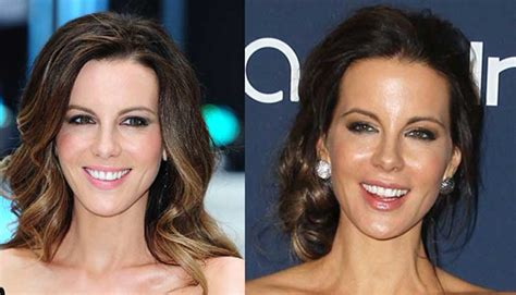 Kate Beckinsale Plastic Surgery: Boob Job, Nose Job, Botox and Teeth