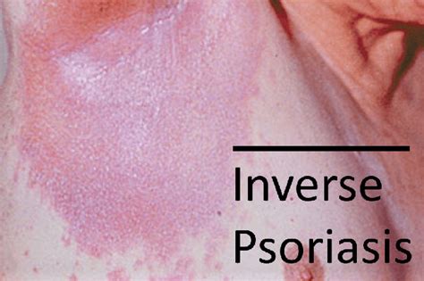 Warnings: 6 Types of Psoriasis and 4 Skin Conditions You Need to Know ...