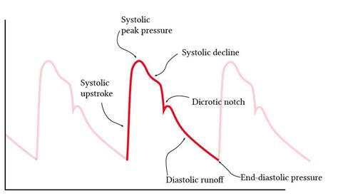 Normal arterial line waveforms | Deranged Physiology Icu Nursing, Nursing Notes, Nursing School ...