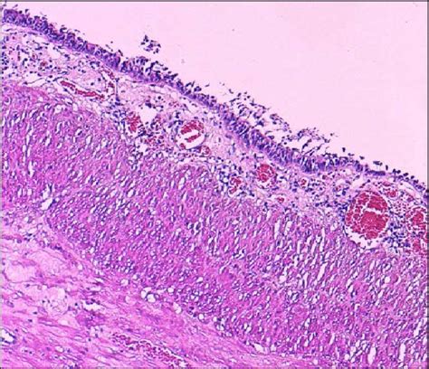 Immature Teratoma Histology