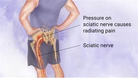 Chiropractic Care for Sciatica Pain Treatment - Wilbeck Chiropractic