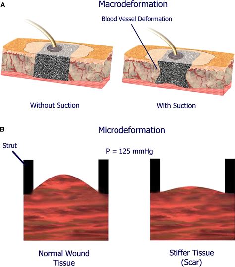 The mechanisms of action of vacuum assisted closure: More to learn ...