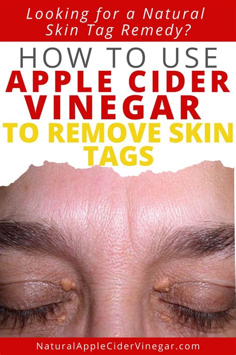 How to Use Apple Cider Vinegar to Remove Skin Tags in 2020 | Skin tags ...