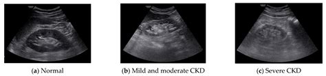 Normal Pediatric Renal Ultrasound