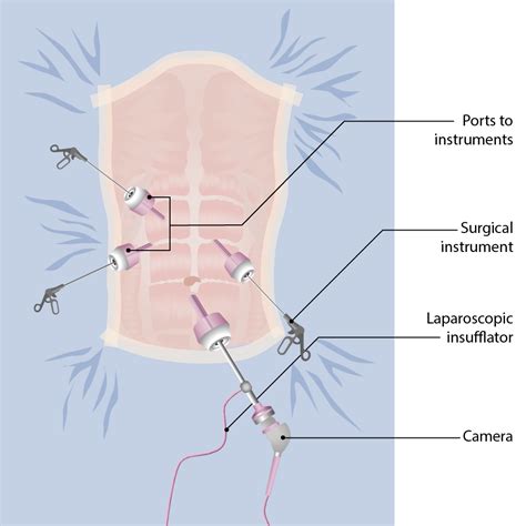 Laparotomy and Laparoscopy | Concise Medical Knowledge