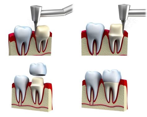 Crown Lengthening - Lake Plaza Dental- Locust Grove Dentist