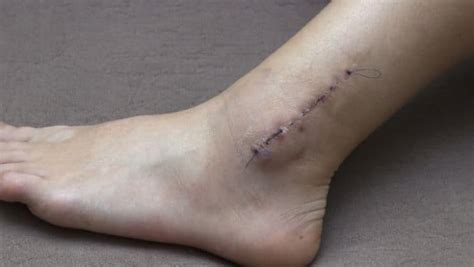 Ankle Surgery - Exercises For Injuries