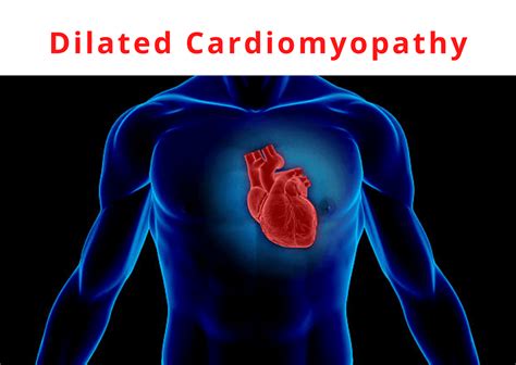 Dilated Cardiomyopathy