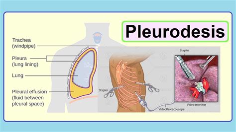 pleurodesis - YouTube