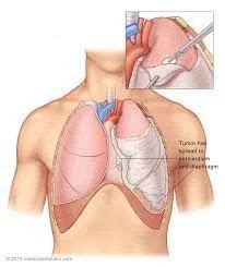 Lung Resection Decortication Treatment in Ahmedabad | ID: 7860670673